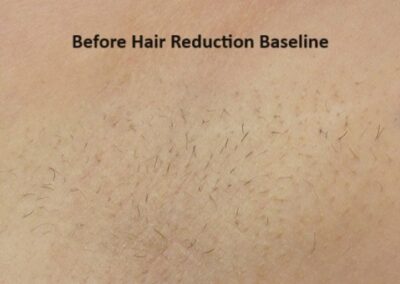Before treatment baseline of underarm hair prior to miraDry hair reduction procedure.