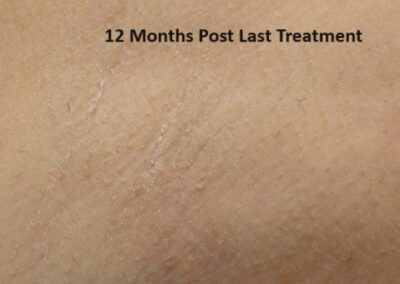 Underarm area 12 months after the last miraDry treatment showing long-term hair reduction results.