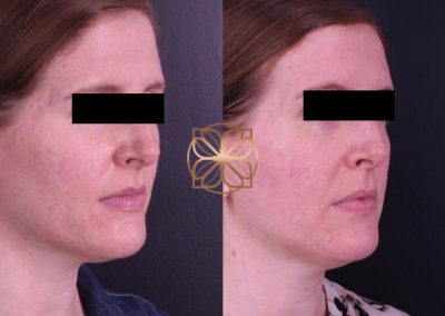 Morpheus, Halo, Profractional Laser, and Microlaser Peel Spa26 Beverly Hills