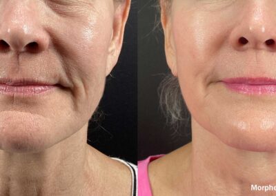 Before and after results of Morpheus8 Burst treatment for skin rejuvenation.
