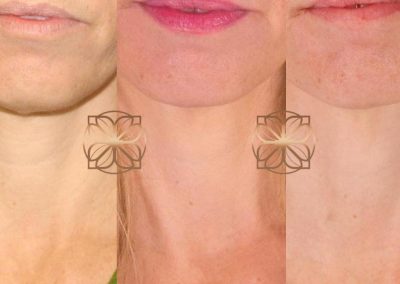 Neck Pelleve Spa26 Beverly Hills.pptx