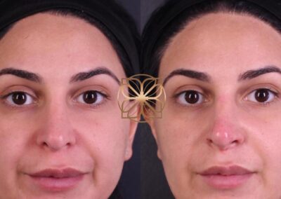 Before and after results of a non-surgical nose job with filler, showing enhanced nasal shape and symmetry