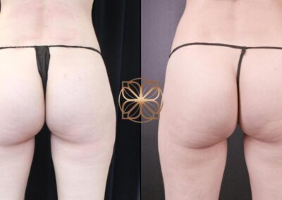 Before and after one month results of a nonsurgical Brazilian Butt Lift (BBL) showing enhanced buttock fullness and shape