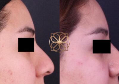 Profile view showing the transformation from a liquid nose job with nose filler, highlighting subtle reshaping and symmetry
