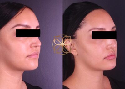 Profile view of comprehensive facial fillers for nose, lips, tear troughs, and chin augmentation, revealing contour enhancements