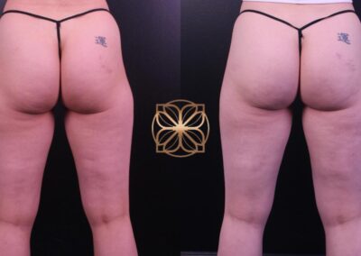 Before and after results of Outer Thigh Liposuction and Cellfina treatment in Beverly Hills, showing enhanced thigh contour and cellulite reduction
