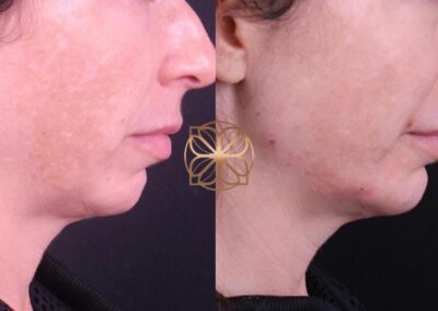 Profile view before and after PicoFocus Pigment Reduction and Filler, showing reduced pigmentation and smoother skin contour