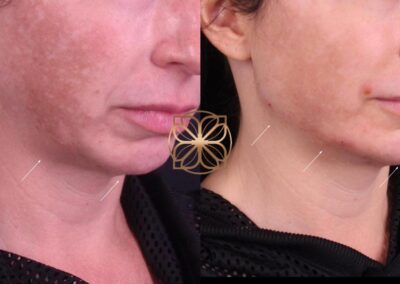 Side view of skin before and after PicoFocus Pigment Reduction and Filler Treatment, showing clearer skin and enhanced facial volume
