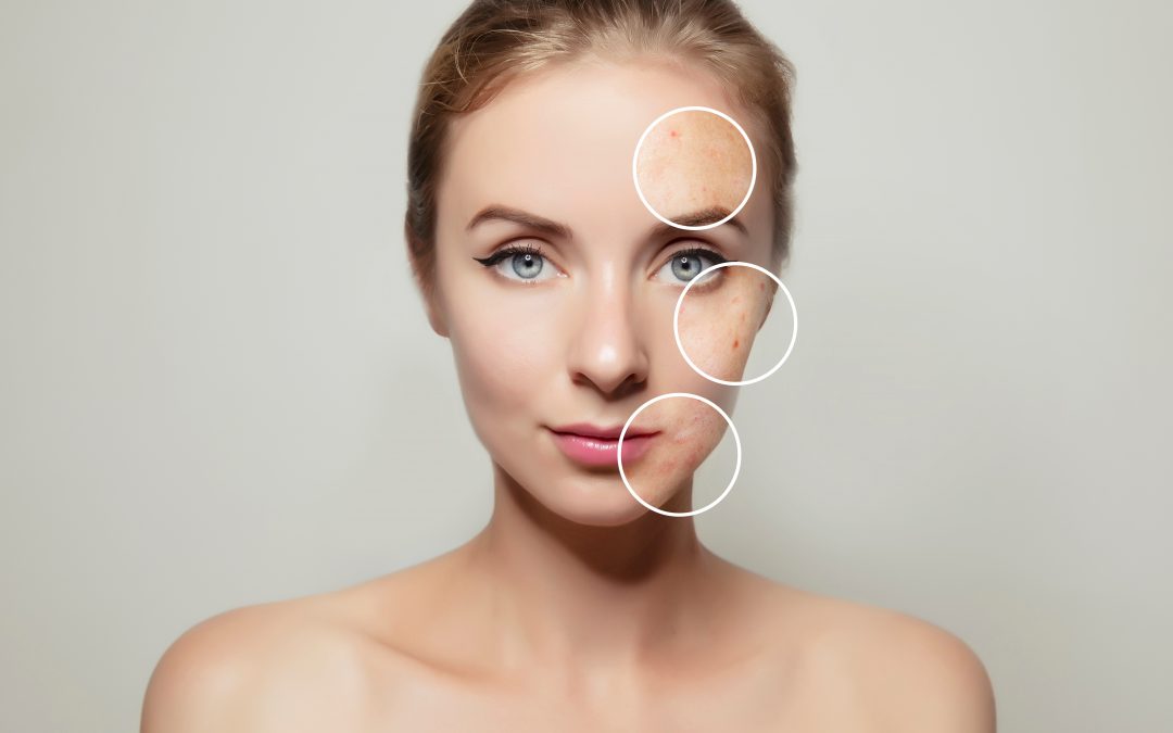 PicoFocus Pigment Reduction Beverly Hills