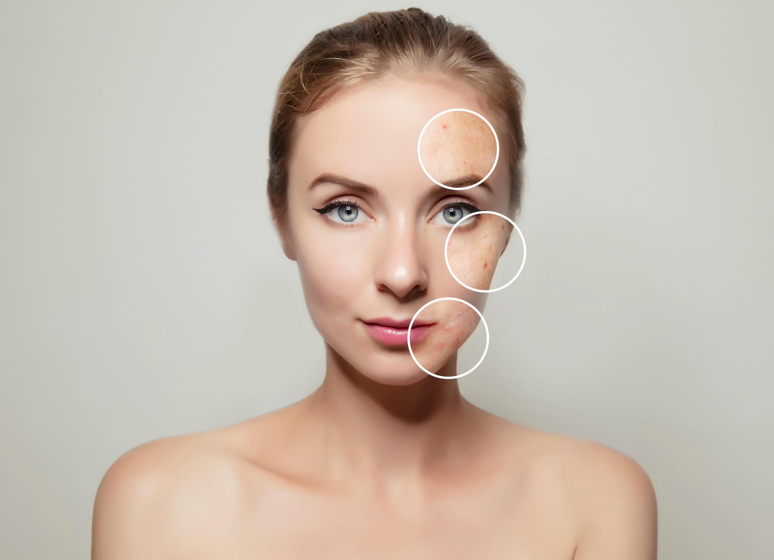 Woman,Face,Portrait,With,Clear,And,Pimpled,Skin,/,Skin picofocus pigment reduction woman face treatment