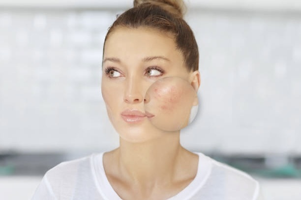 PicoFocus Pigmentation Reduction Aftercare and Recovery