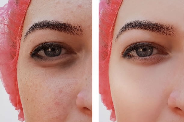 PicoFocus Pigmentation Reduction Benefits