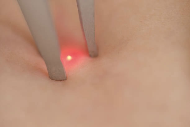 PicoFocus Pigmentation Reduction Side Effects and Risks