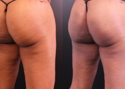 Posterior thigh comparison before and after two QWO cellulite reduction sessions, showing significant skin texture improvement