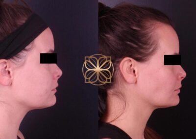 Profile comparison 3 months post-FaceTite and BFPR treatment, showing visible skin tightening and contouring in a Beverly Hills clinic