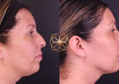 Profile view showing the defined contours and improved skin texture after a 3-month FaceTite treatment course