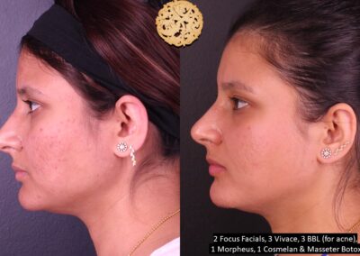 Side profile view of a woman before and after undergoing skin treatments, revealing clearer and smoother skin.
