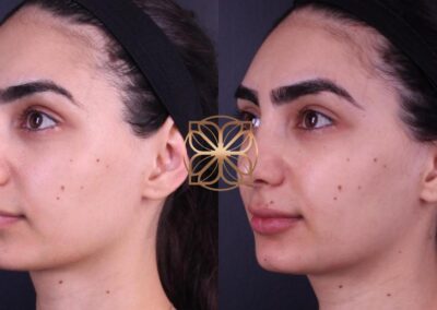 Profile view before and after face filler treatments for lips, nasolabial folds, marionette lines, and nose, showing subtle volume addition and contouring