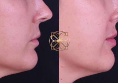 Profile view showcasing lip augmentation results before and after filler treatment, with enhanced lip volume and definition