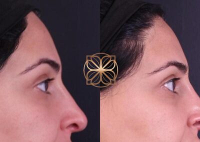 Side profile comparison before and after non-surgical nose job with filler, highlighting the refined nasal profile