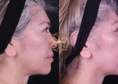 Profile view facial rejuvenation with filler and lower blepharoplasty after 2 months, showing a more youthful contour and reduced under-eye sagging