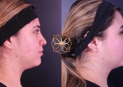 Side profile transformation after BFPR and FaceTite skin tightening treatments in Beverly Hills