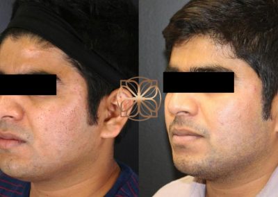 Profractional Laser Resurfacing After 2 Days Spa26 Beverly Hills