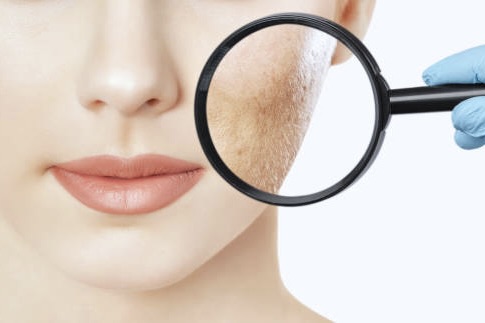 Profractional Laser Resurfacing Aftercare and Recovery