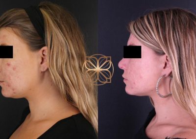 Profractional Laser Resurfacing Spa26 Beverly Hills
