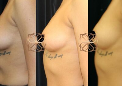Progressive sequence showing the results of PRP Breast Booster for natural breast lifting and enhancement