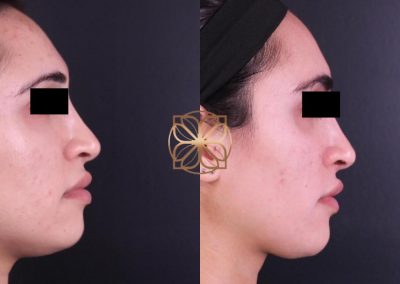 PRP After 3 Treatments, Power Peel, 3 BBL, 4 Diamond Glow, Filler to Lips, Jaw, Tear Troughs, Temples, & Marionettes Spa26 Beverly Hills