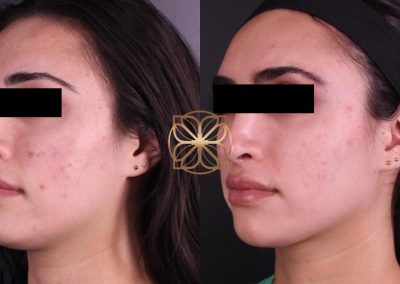 PRP After 3 Treatments, Power Peel, 3 BBL, 4 Diamond Glow, Filler to Lips, Jaw, Tear Troughs, Temples, & Marionettes Spa26 Beverly Hills