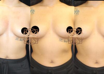 Before and after results of PRP Breast Booster treatment showing natural breast enhancement