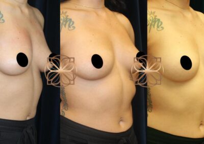 Stages of breast enhancement and lift through PRP Breast Booster treatment, demonstrating volumization