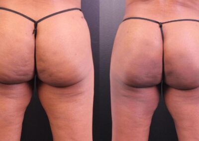 Before and after QWO treatment on buttocks, demonstrating cellulite reduction and skin smoothing after two sessions