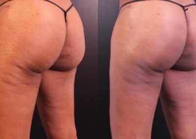 Before and after QWO cellulite reduction treatment, with visible smoothing of skin on the thighs after two sessions