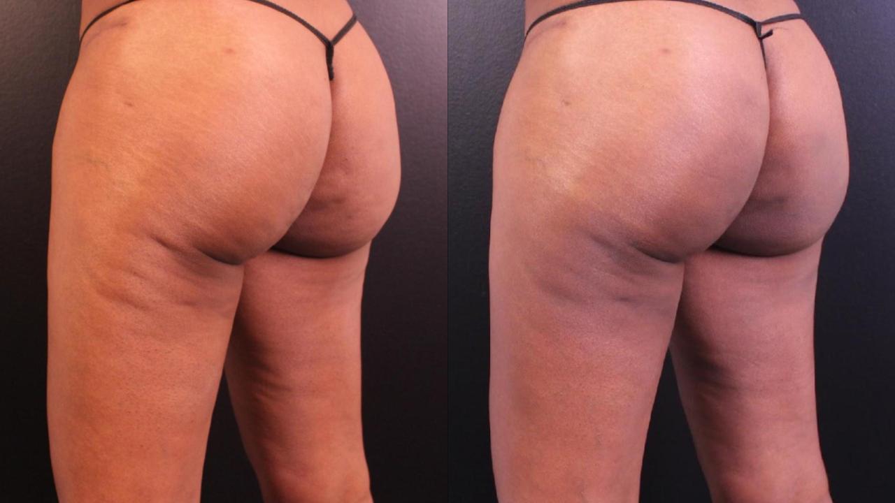 Before and after QWO cellulite reduction treatment, with visible smoothing of skin on the thighs after two sessions