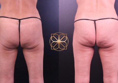Rear view comparison showcasing the transformation achieved with buttocks filler treatments for enhanced shape