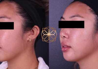 Side profile view of facial enhancements with fillers to midface, tear troughs, lips, chin, and Botox treatment