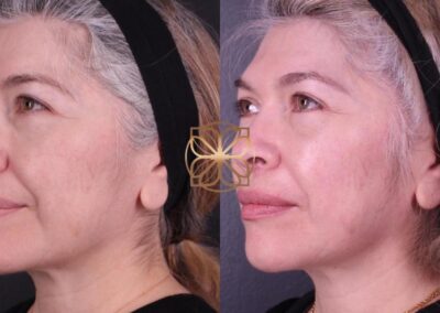 Side profile before and after facial fillers and lower blepharoplasty, illustrating enhanced facial volume and eye area rejuvenation after 2 months