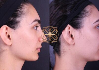 Side profile before and after facial fillers, illustrating improvements in nose, lips, and chin definition