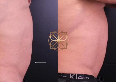 Side profile view before and after Kybella fat reduction treatment, showcasing a slimmer and more defined abdomen