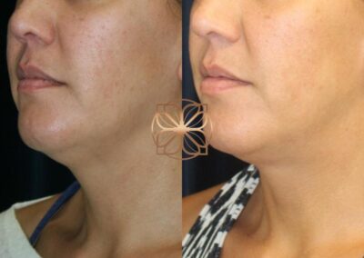Side profile view of the effects of Kybella treatment, showcasing a more defined jawline and reduction in neck fullness