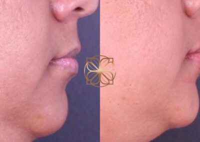 Side profile comparison of lip augmentation with filler treatment, highlighting the enhanced lip volume and definition