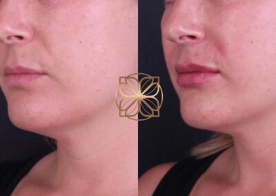 Side profile comparison of lip filler enhancement, highlighting improved lip shape and contour after treatment