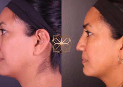Enhanced side-profile view post-FaceTite and Morpheus8 skin treatment showcasing tightened and revitalized facial features
