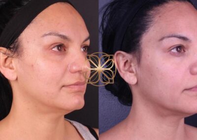 Side view before and after comparison of face and neck enhancement, demonstrating aesthetic treatment effects
