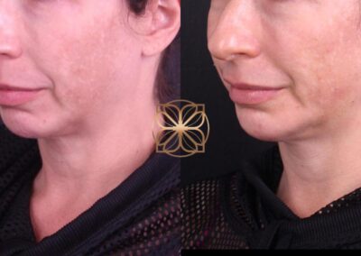 Side view of skin rejuvenation with PicoFocus and Filler Treatment, illustrating pigment correction and improved skin texture