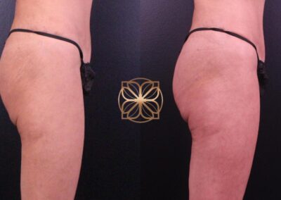 Side view before and after image of buttocks contouring and volumization from filler treatments