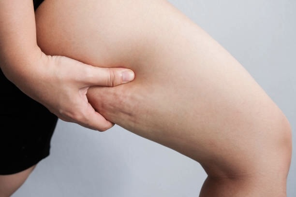 Similar and Related Procedures to Cellfina Cellulite Reduction